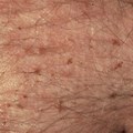 Bites From Pubic Lice