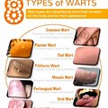 Different Types of Warts On Genital