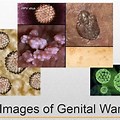Genital Warts Look Like