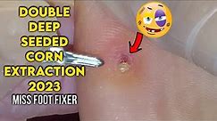 EXTRACTION OF DOUBLE DEEP SEATED CORN ON SOLE OF FEET 2023 BY FAMOUS PODIATRIST MISS FOOT FIXER
