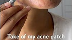 Peel of acne patch. #acne #acnepatch #pimplepatch #cystic #cystpoping #cyst #acnetreatment #pimples