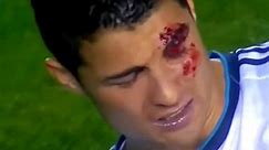 Eye Injury Of Rolando 🥶 #revenge #shorts #ronaldo