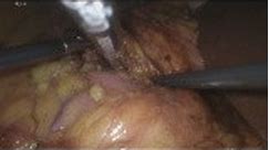 Simultaneous Laparoscopic Right Adrenalectomy and Right Renal Tumorectomy • Video • MEDtube.net