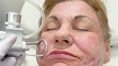 The fractional CO2 laser is a cosmetic procedure that employs a CO2 laser to enhance skin appearance. By generating minuscule columns of controlled injury, it encourages the production of collagen and elastin, thereby diminishing fine lines and enhancing both texture and tone. This treatment is effective for addressing issues such as acne scars, age spots, sun damage, and more. To schedule this procedure with us, call : ☎️(954) 456-4777 ☎️ (561) 485-1580 #drhegedosh #microneedling #bocaraton #we