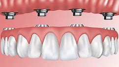 Permanent False Teeth Prices In Johannesburg. Full Details - South Africa Insider