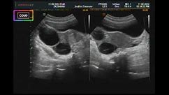 Ultrasound video of Right ovarian simple cyst