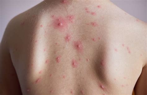 20 Common Skin Lesions and How to Spot Them