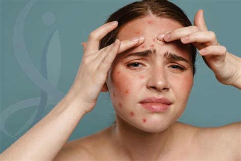 Is Acne a Side Effect of Mounjaro? Causes and Solutions