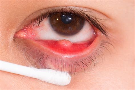 Eye Stye Treatment: Causes, Symptoms and Treatments