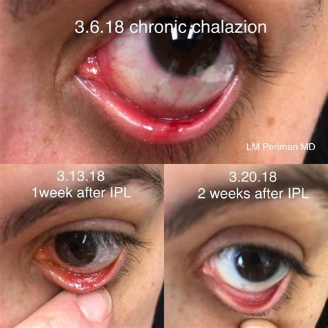 Chalazion Removal Near Me Treatment and Recovery Options • gzu.ac.zw