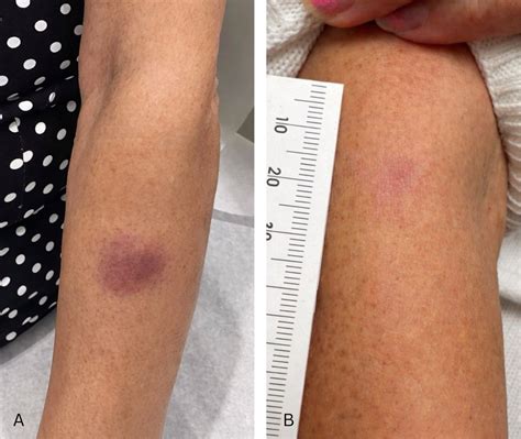 Primary cutaneous marginal zone lymphoma presenting as a violaceous forearm plaque | BMJ Case ...