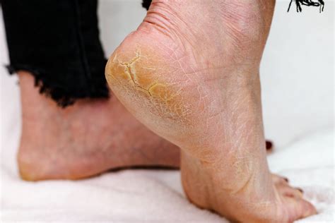 How to Remove Dry Skin from Feet Naturally ⋆ ctf.bnsf.com