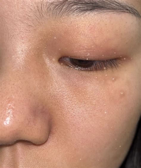 Recurrent Milia Seeds: When Re-Assessment Is More Important Than Re-Treatment — Singapore best ...