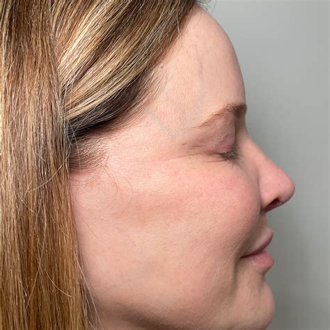 2026 Laser Resurfacing Guide | CO₂, MOXI, BBL & Clear + Brilliant