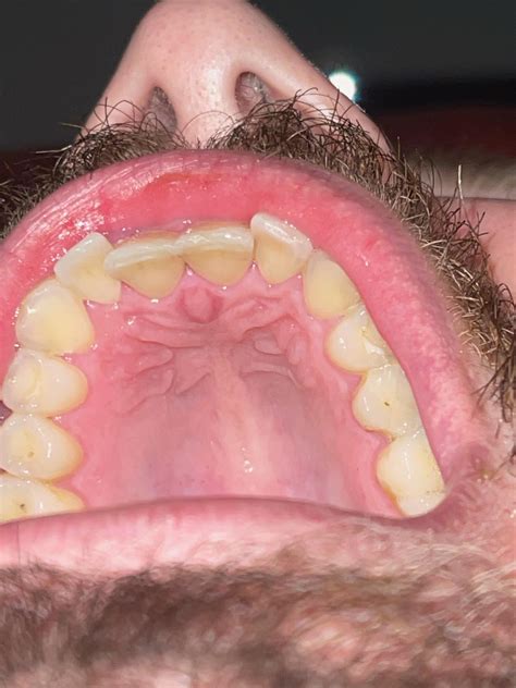 Is there something wrong with the roof of my mouth, I'm worried it ...