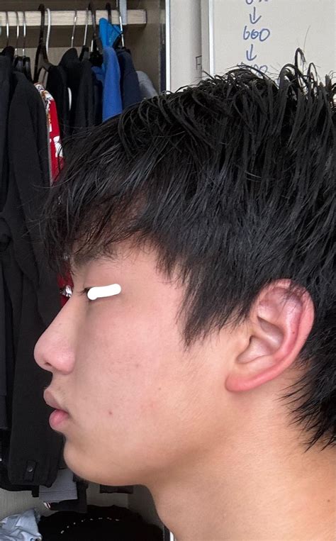 Surgery to fix mouth breathing face. : r/jawsurgery