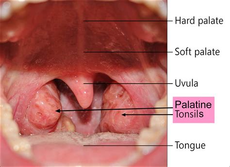 Tonsillectomy - Indications, Recovery Time, Cost, and Complications