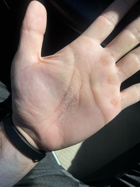 Very itchy, dry patch in the middle of my palm. : r/DermatologyQuestions