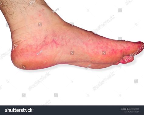 Secondary Syphilis Rash On Man Feet Stock Photo 2291965337 | Shutterstock