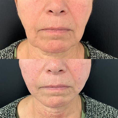 Non-surgical Jowl Lift | Thread Lift, HIFU, Injectables & Fillers for Jowl