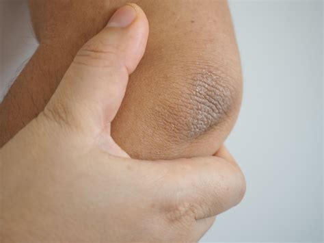 ¿Es posible aclarar los codos y rodillas oscuras en los niños?