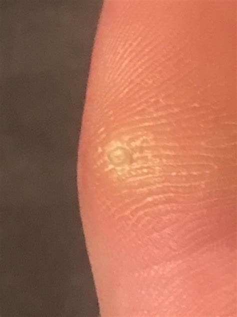 Yellow raised spot on big toe : r/DermatologyQuestions