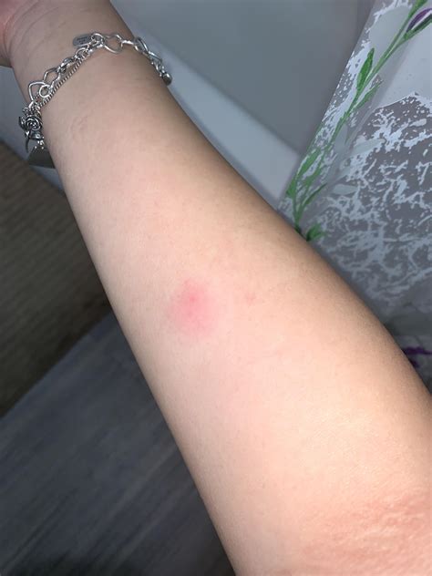 Bad Tb Test Looks Like