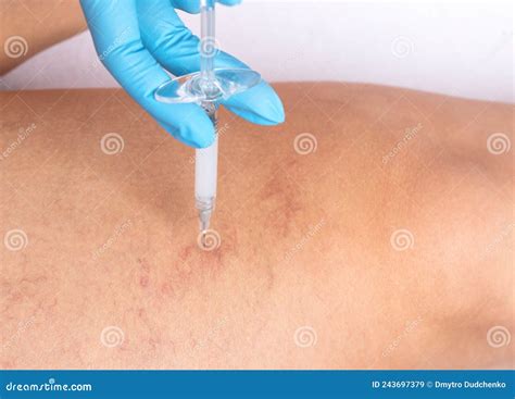 Removal of Varicose Veins on the Legs. Medical Inspection and Treatment of Telangiectasia Stock ...