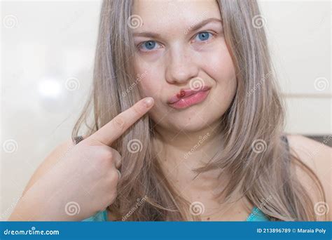 Herpes on the Lips of a Girl. Young Woman with Herpis Virus on Her Lip, Touching Her Lip with ...