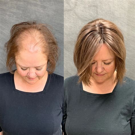 Hair Thinning At Crown