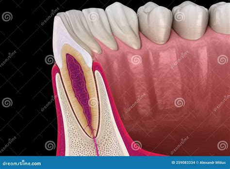 Anatomy of Maxillary Lateral Incisor Tooth and Gum Cross Section ...