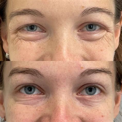 What Causes Crow's Feet And How Can You Treat Them - t-a-s-h-a.com