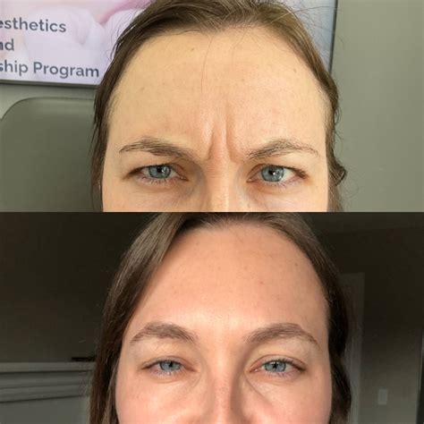 Botox Before & After Gallery - Nurse Jacklyn