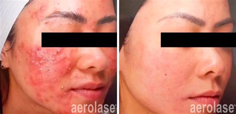 The Ultimate Solution for Post-Acne Hyperpigmentation and Scarring