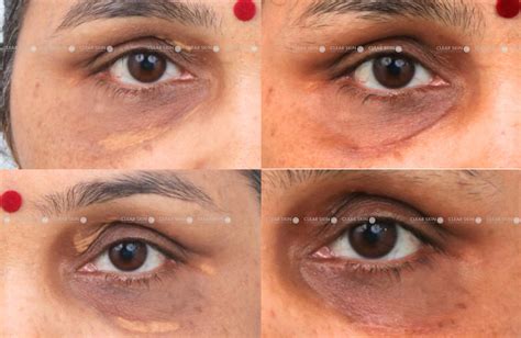 Xanthelasma Treatment In Pune | Clear Skin, Pune