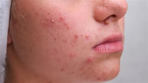 Fungal Acne On Face