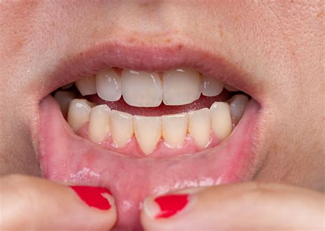 Why do I have receding gums?