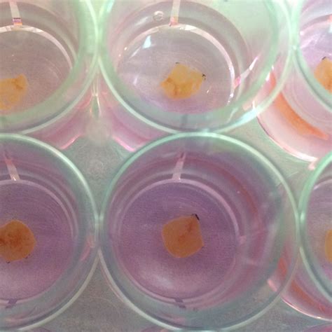 Improving the Outlook for Simultaneous Pancreas-Kidney Transplants ...