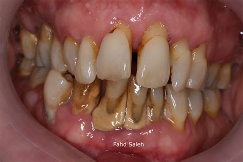 Severe Periodontitis 3 Types Of Treatment For Gum Disease All Smiles