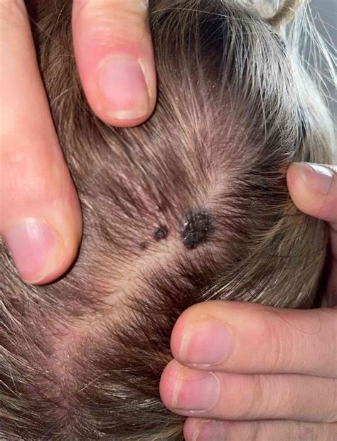 Skin Cancer Moles On Scalp