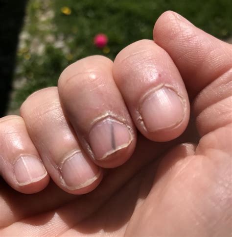 How to Get a Splinter out from under the Nail? – DTK Nail Supply - splinter under fingernail