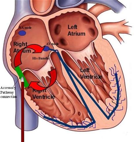 The Implantable Medtronic Cardiac Loop Recorder: A Personal Experience ...
