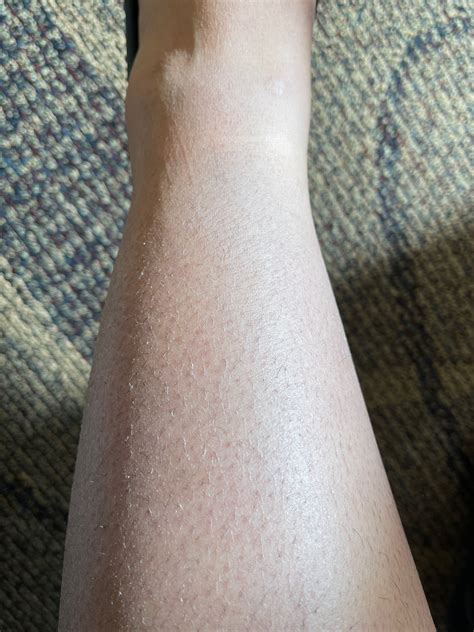 The Lines On Skin Leg