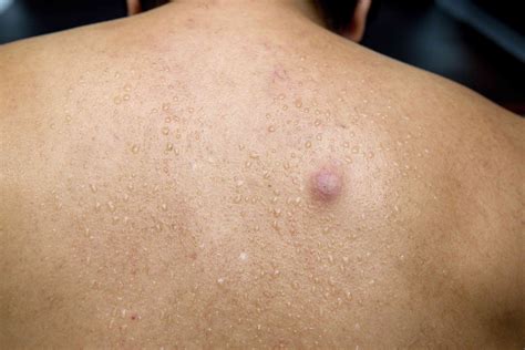 17 Common Causes of Raised Skin Bumps (With Pictures)