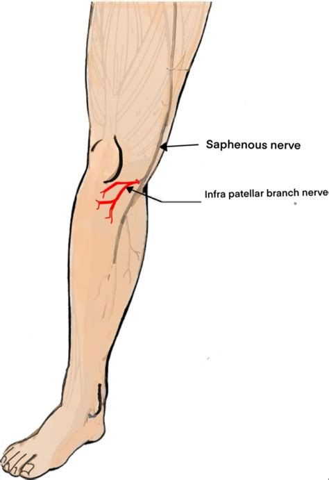Saphenous Nerve Entrapment /Gonalgia paresthetica. Introduction : The ...
