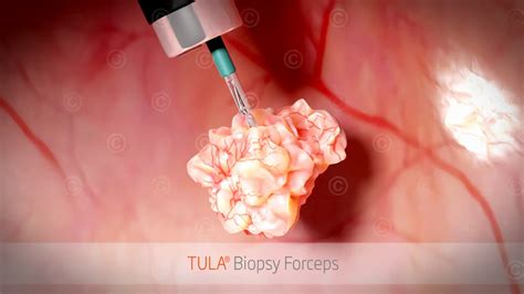 Animation bladder cancer treatment - MedicalGraphics