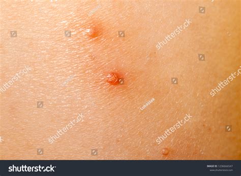 Close Molluscum Contagiosum Called Water Wart Stok Fotoğrafı (Şimdi ...
