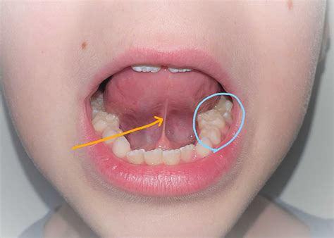 Types Of Tongue Tie Baby at Reynaldo Leahy blog