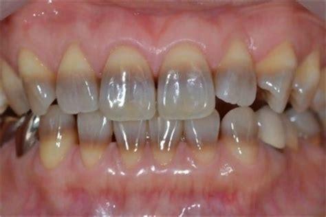 Stained Teeth London Expert Solutions | Dulwich Dental Office