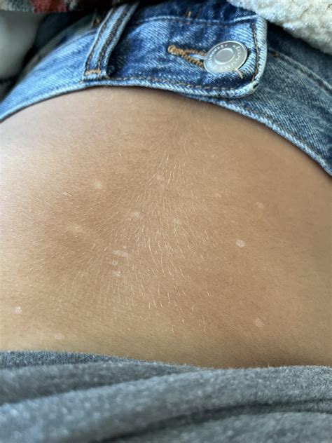 Dry white spots on my stomach and shoulders : r/DermatologyQuestions